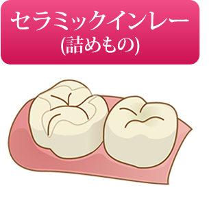 セラミックインレー(詰めもの)