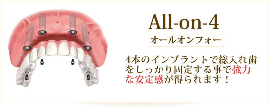 「All-on-4　オール・オン・フォー」4本のインプラントで総入れ歯をしっかり固定する事で強力な安定感が得られます！